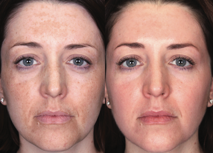 Before and after results from a Melanage peel