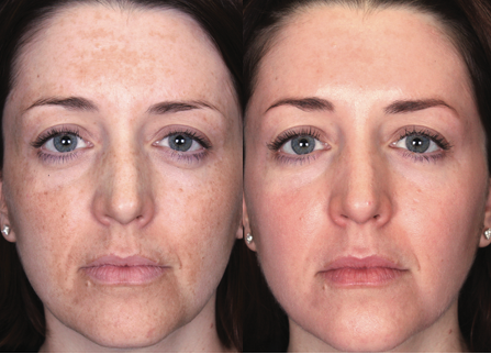 Stock before and after image for Melange peel